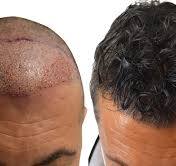 Il trapianto dei capelli risolve i problemi di centinaia di uomini. Vanno però rispettate determinate regole poichè trattasi di un vero e proprio intervento chirurgico.